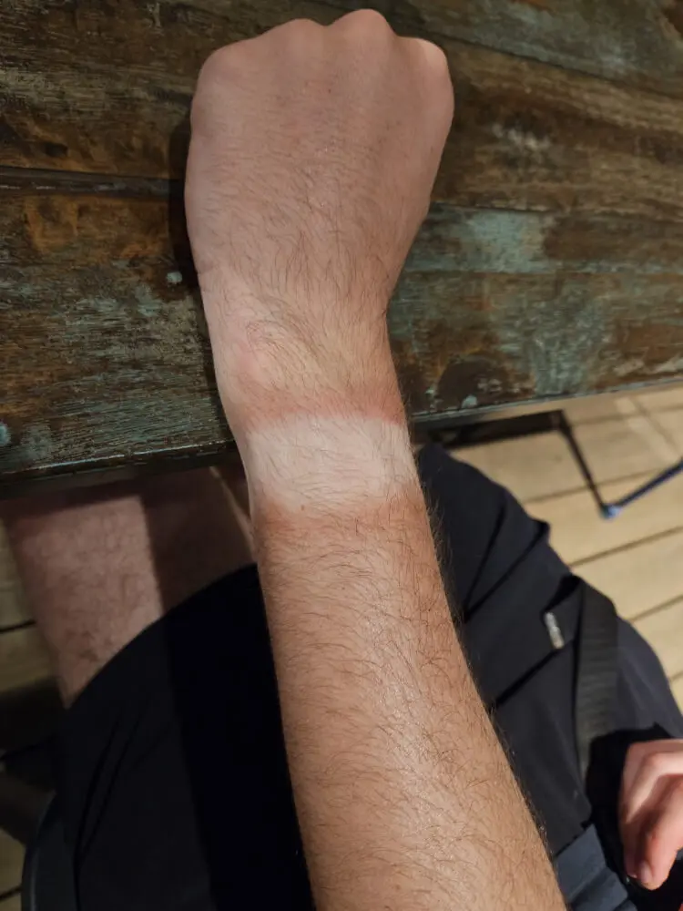 Tom’s Watch Tan Tom's forearm showing a strong watch tan line